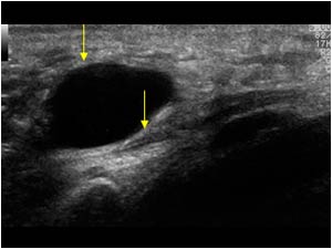 Ganglion cyst compressing the ulnar nerve longitudinal