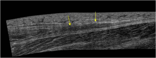 Localized thickening of the plantaris tendon longitudinal
