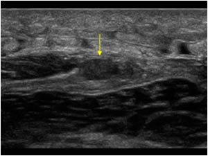 Localized thickening of the plantaris tendon transverse