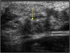 Localized thickening of the nerve transverse