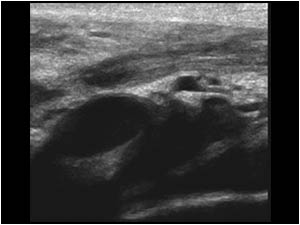 Thickened inflamed spermatic cord in the groin