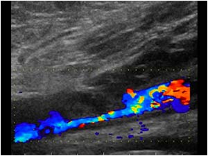 Flow along the thrombus in the popliteal vein
