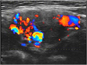 Transverse color Doppler image of the carotid bifurcation shows a highly vascularized mass between the internal and external carotid artery.