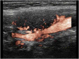 Longitudinal image with e flow of the carotid bifurcation shows a highly vascularized mass along the external carotid artery. The feeding arteries arise from the external carotid artery.