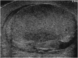 Inhomogeneous hypoechoic testicle