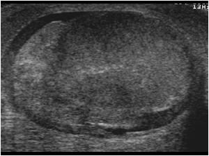 Inhomogeneous hypoechoic testicle