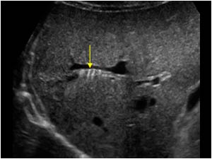 Bile duct stones without stones in the gallbladder