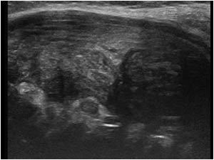 Diffuse infiltration of the left thyroid lobe longitudinal