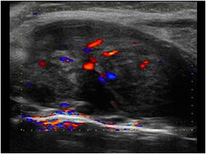 Diffuse infiltration of the right thyroid lobe longitudinal