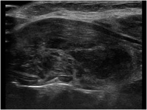 Diffuse infiltration of the right thyroid lobe longitudinal