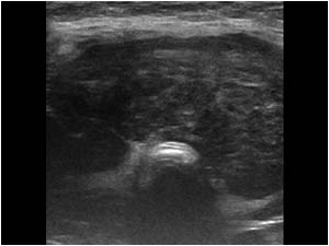 Diffuse infiltration of the isthmus transverse