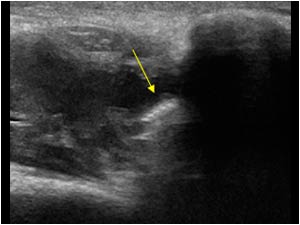 Hematoma and fixation screw penetrating the clavicle longitudinal
