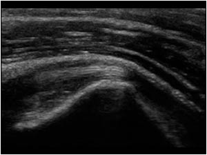 Luxating biceps tendon during exorotation longitudinal