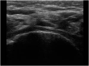 Absent supra and infraspinatus tendon transverse