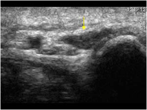 Accessory muscle and Gyon tunnel transverse