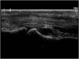 MCP joint with effusion and tenosynovitis of the flexor tendons  longitudinal