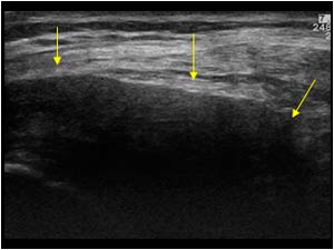 Synovial mass dorsal to the patellar tendon transverse