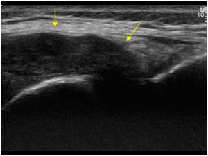 Synovial mass and medial joint space longitudinal