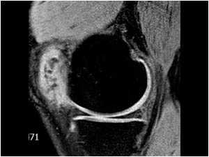 Miscellaneous medial knee