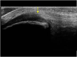 Cartilage swelling and contour irregularity of the patella longitudinal