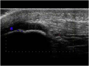 No neovascularity on the normal side longitudinal