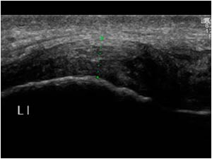 Inhomogeneous thickened proximal ligament