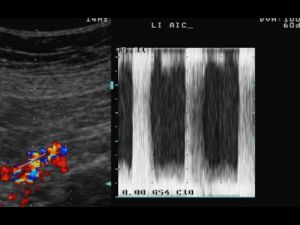 Proximal common iliac artery stenosis with high velocity >5 mtr/sec