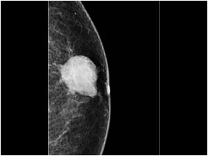 Case of the month September 2007: Malignant breast lesions