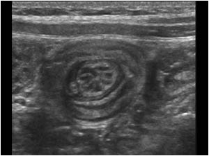 Transverse image of a target shaped lesion in the left upper abdomen. The multilayered lesion represents an intussusception.