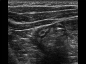 In the right lower abdomen a normal appendix was found in a normal position.
This eliminates an abnomal position of the cecum, confirming that the intussusception found in the left upper abdomen is not an iliocolic intussusception.