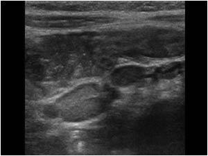 Image of 2 mesenteric lymph nodes. The presence of mesenteric lymph nodes in children is non specific.
No peritoneal fluid or bowel dilatation was found.
The intussusception did not resolve during the time of the ultrasound examination. Because small bo