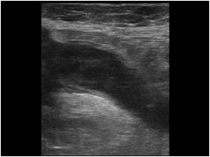 Longitudinal image of the thickened and not compressible appendix