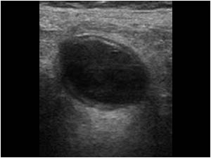 Transverse image of the thickened and not compressible appendix