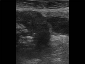 Longitudinal image of the base of the appendix shows an obstructing mass