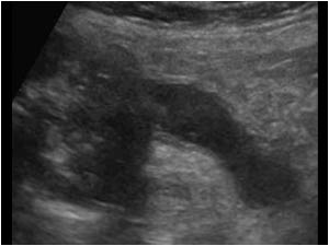Longitudinal image of the cecum and appendix with a large cecal mass obstructing the base of the appendix and the thickened fluid filled inflamed appendix