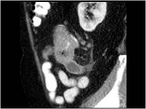 CT image with the cecal mass and thickened appendix