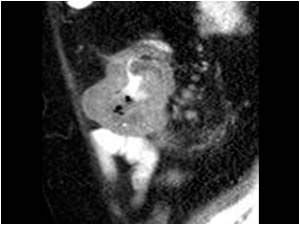 CT image with the cecal mass