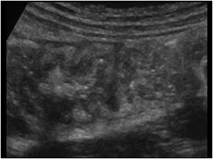 Thickening of the wall of the ascending colon longitudinal