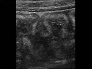 Thickening of the wall of the ascending colon longitudinal