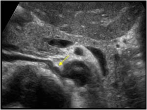 Left renal vein dorsal to the aorta transverse