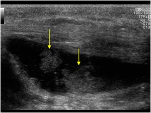 Synovial thickening