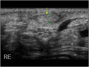 Slightly thickened palmaris tendon proximal to the rupture