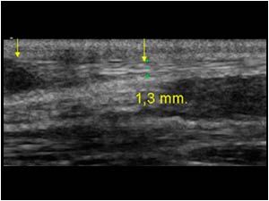 Rupture of the palmaris tendon and thickening proximal longitudinal