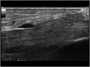 Intact posterior tibial tendon longitudinal