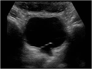 Small ureterocele like cystic structure at the site of the left ureteric orifice