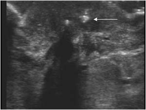 Ultrasound image of the nipple with calcifications