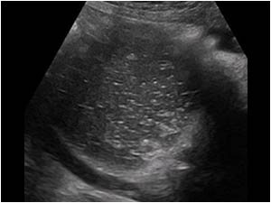 Case of the month January 2009: Dermoid cysts / cystic teratomas