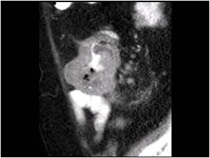 Case of the month April 2009: Abnormalities mimicking an acute appendicitis