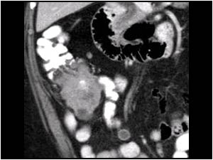 Case of the month April 2009: Abnormalities mimicking an acute appendicitis