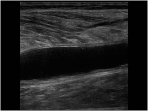Longitudinal image of the calf with an anechoic structure between the medial gastrocnemius and the soleus muscle.